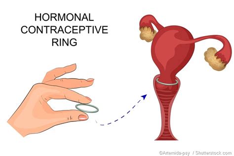 how to insert a diaphragm cap or vaginal ring