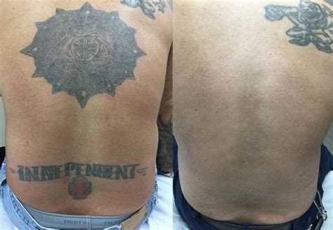 laser tattoo removal before and after removery