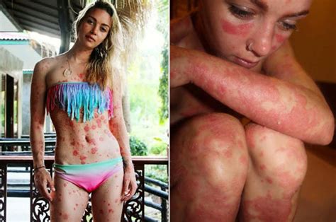 psoriasis sufferer finally feels beautiful after years of