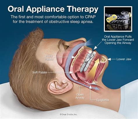 oral appliances sandy springs atlanta ga and cumming ga atlanta ent