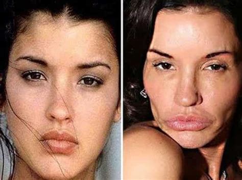 19 freaky cases of lip injections gone wrong