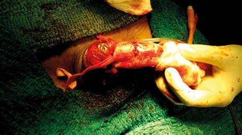 penile fracture urology news