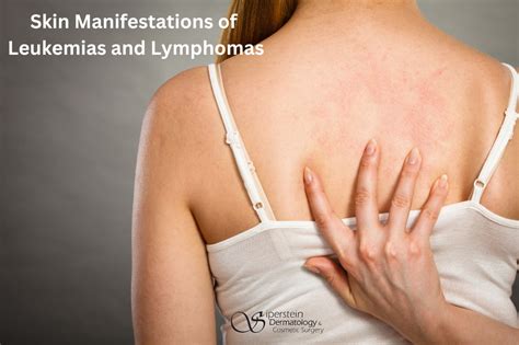 skin manifestations  leukemias  lymphomas siperstein dermatology