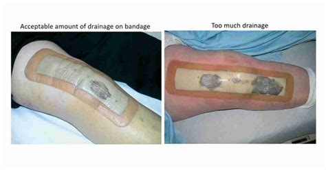 wound management orthopedic surgery recovery