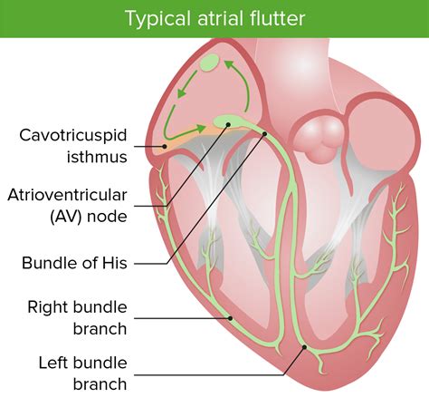 Atrial Flutter Concise Medical Knowledge