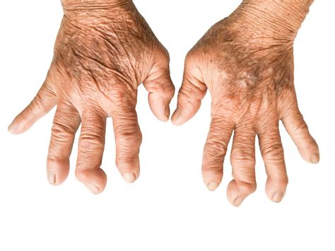 rheumatoid arthritis  penyebab nyeri sendi