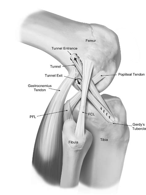 lemaire technique  fcl fibular collateral ligament pfl