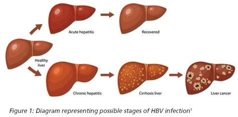 chronic hepatitis  virus hbv university hospitals sussex nhs