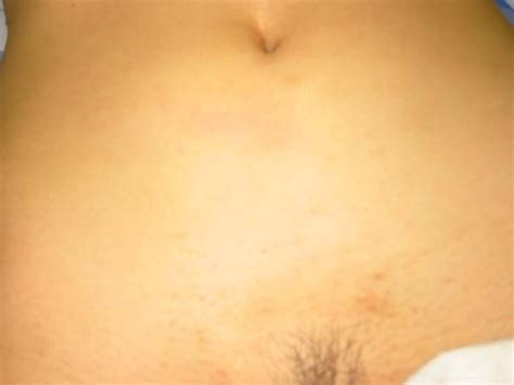 masturbation after abdominal myomectomy sex photo