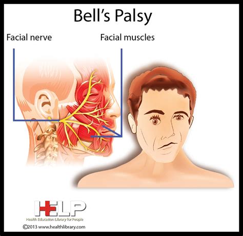 cranial nerve shingles