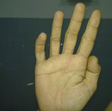 medical pictures info claw hand