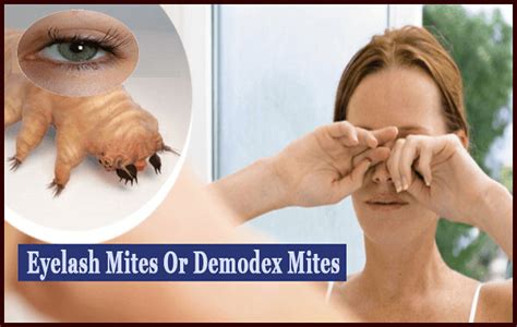 eyelash mites  symptoms treatments prevention flickr