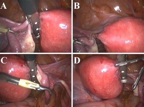 hysterectomy advantages and disadvantages of uterus removal