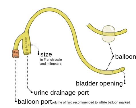 difference  stent  catheter pediaacom