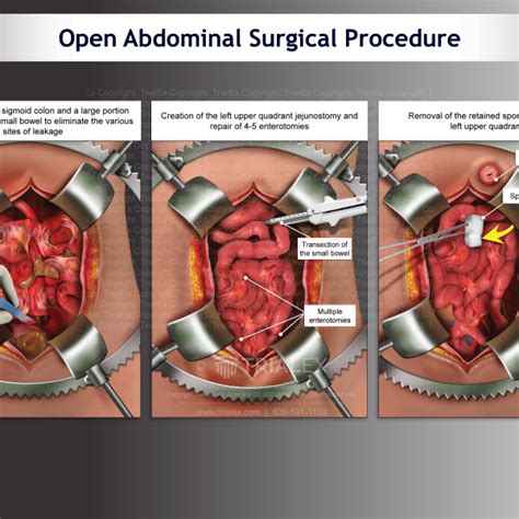 open abdominal surgical procedure trialexhibits