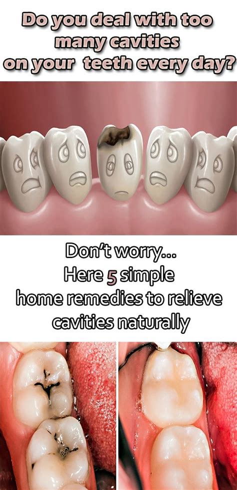 top  effective home remedies   rid  tooth decay tooth cavity