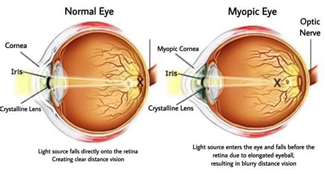 myopia control  singapore