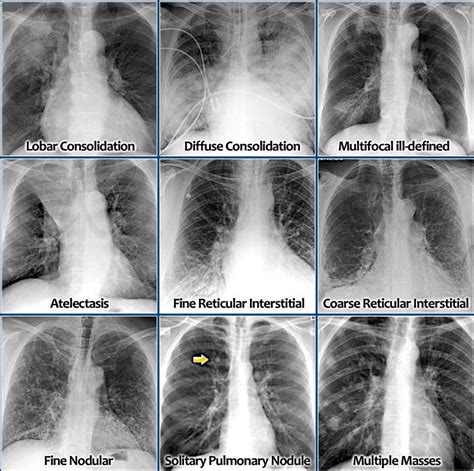 Lobar Pneumonia Chest X Ray Findings Malayelly