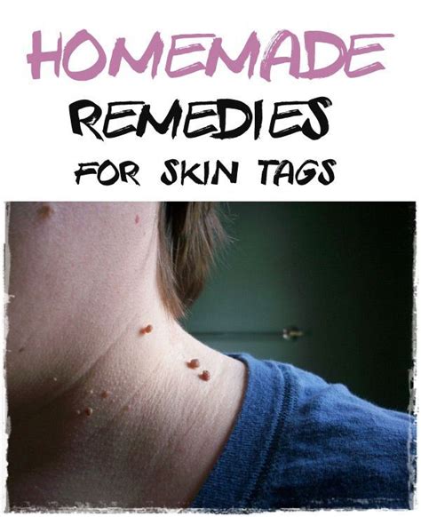 12 natural remedies for skin tag removal home remedies