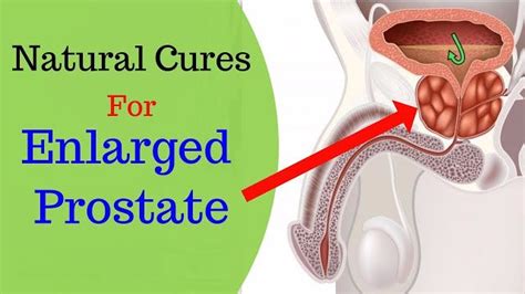 Natural Solution To Prostate Problems Enlarged Prostate Prostate