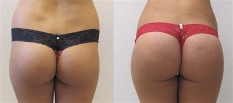 nonsurgical butt augmentation using sculptra yelp