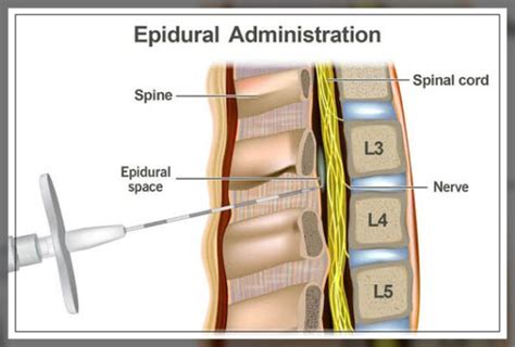 epidural injection    procedure   engiomed