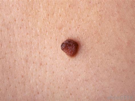 Over 11 Moles On Arm Can Predict Deadly Skin Cancer Risk The