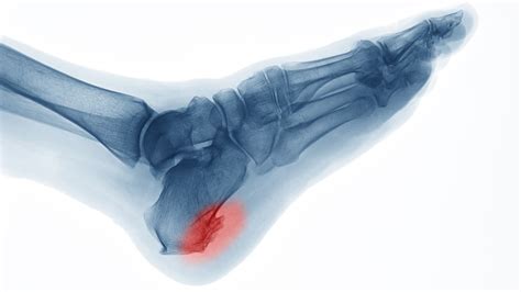 Bone Spur Pain Why Relief May Be Simpler Than You Think