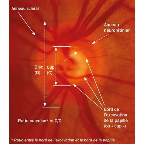 revue de sante oculaire communautaire glaucome  papille optique