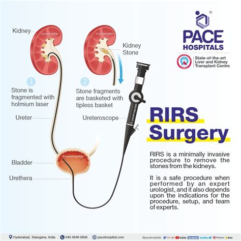 Rirs Surgery In Hyderabad – Indications Side Effects And Benefits