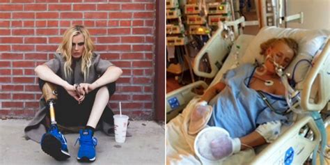 24 Year Old Model Who Lost Her Leg From Using Tampons I Was 10