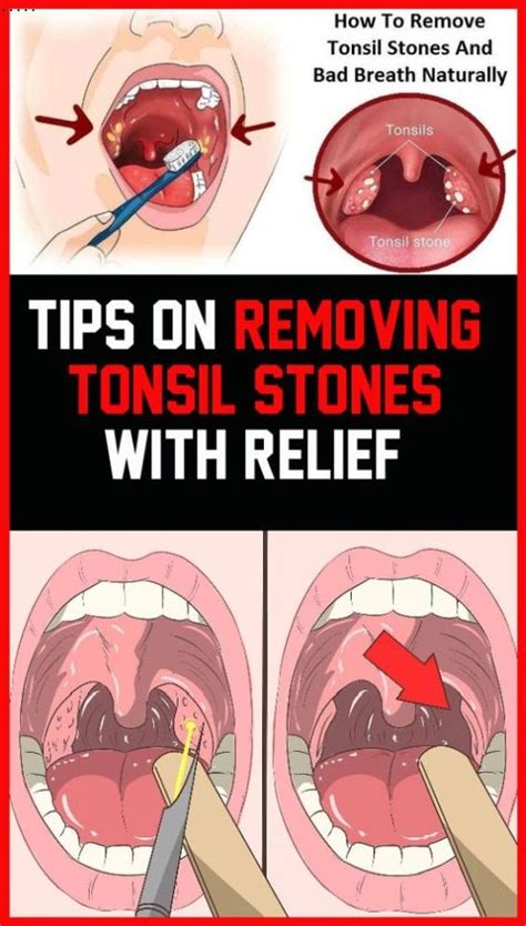 tips  removing tonsil stones  relief wellness magazine