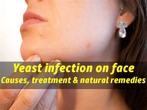 yeast infection on face causes treatment and natural home remedies