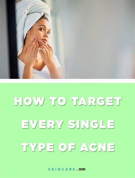 from blackheads to papules acne can show itself in many different forms