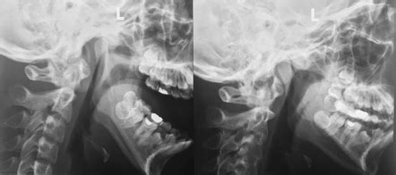 normal tmj open  shut radiographs radiology case radiopaediaorg