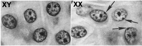 Genética Y Biología Molecular Inactivación Del Cromosoma X
