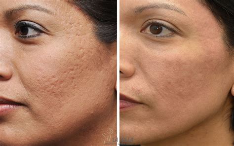 acne scar archives comprehensive dermatology center  pasadena