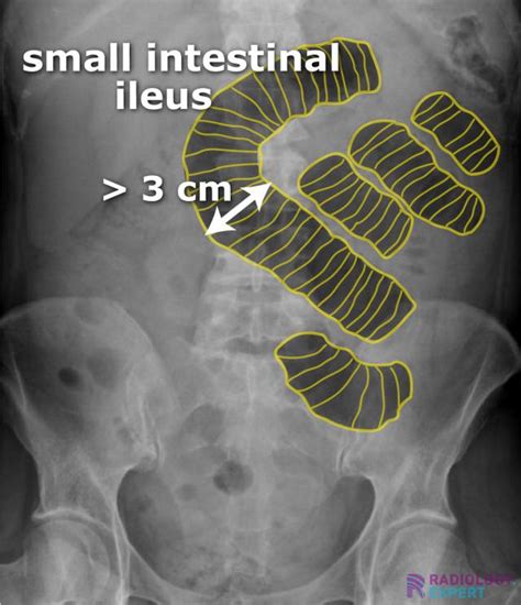 small bowel obstruction air fluid levels