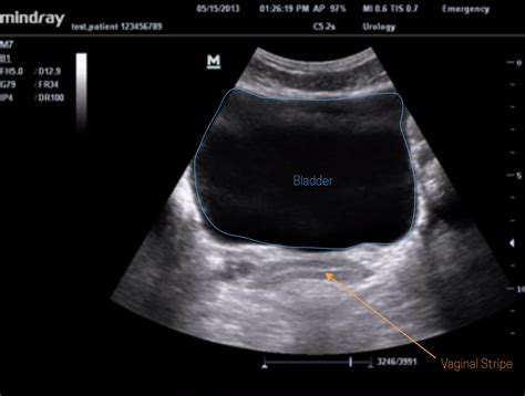 Ultrasound Leadership Academy The Basics Of Pelvic Transabdominal