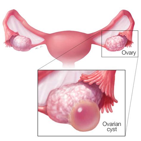 Ovarian Cyst Dr Tatheds Homeopathy