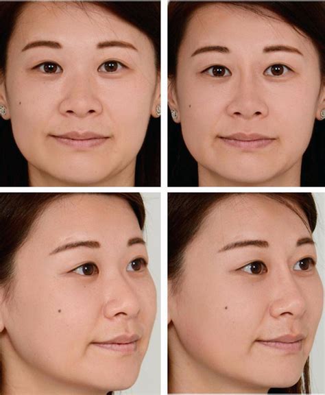 Asian Nose Job Experience Pictures Rhinoplasty Cost