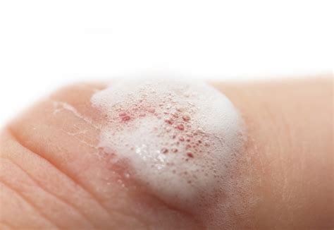 medical myth buster hydrogen peroxide  wounds