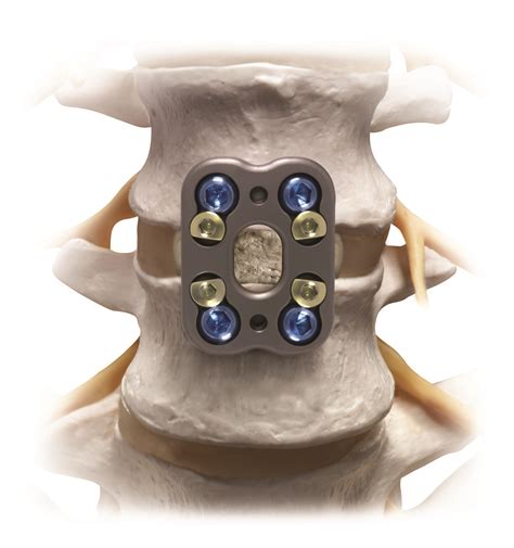 Citadel® Anterior Lumbar Fusion System Globus Medical