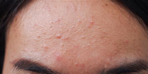 fungal acne  symptoms treatments prevention
