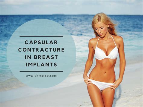 lets talk about capsular contracture in breast implants