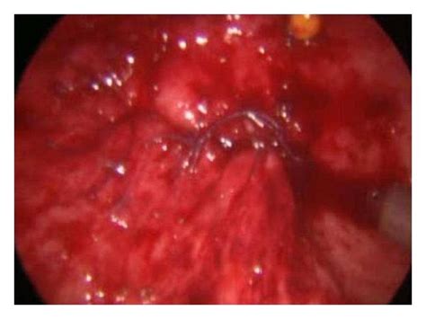 Transvesicoscopic Repair Of Vesicovaginal Fistula