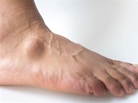 ganglion cyst   foot  ankle podiatry hotline