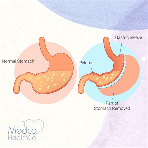gastric sleeve surgery medco healthco stay safe  healthy