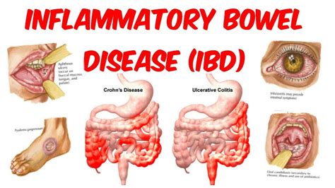 inflammatory bowel disease ibd health life media