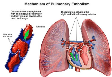 Pulmonary Embolism Treatment In New Jersey Lung Vascular Care